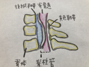 頚椎後縦靭帯骨化症（OPLL）