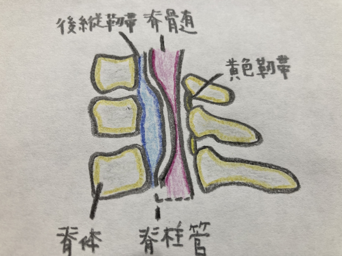 頚椎後縦靭帯骨化症