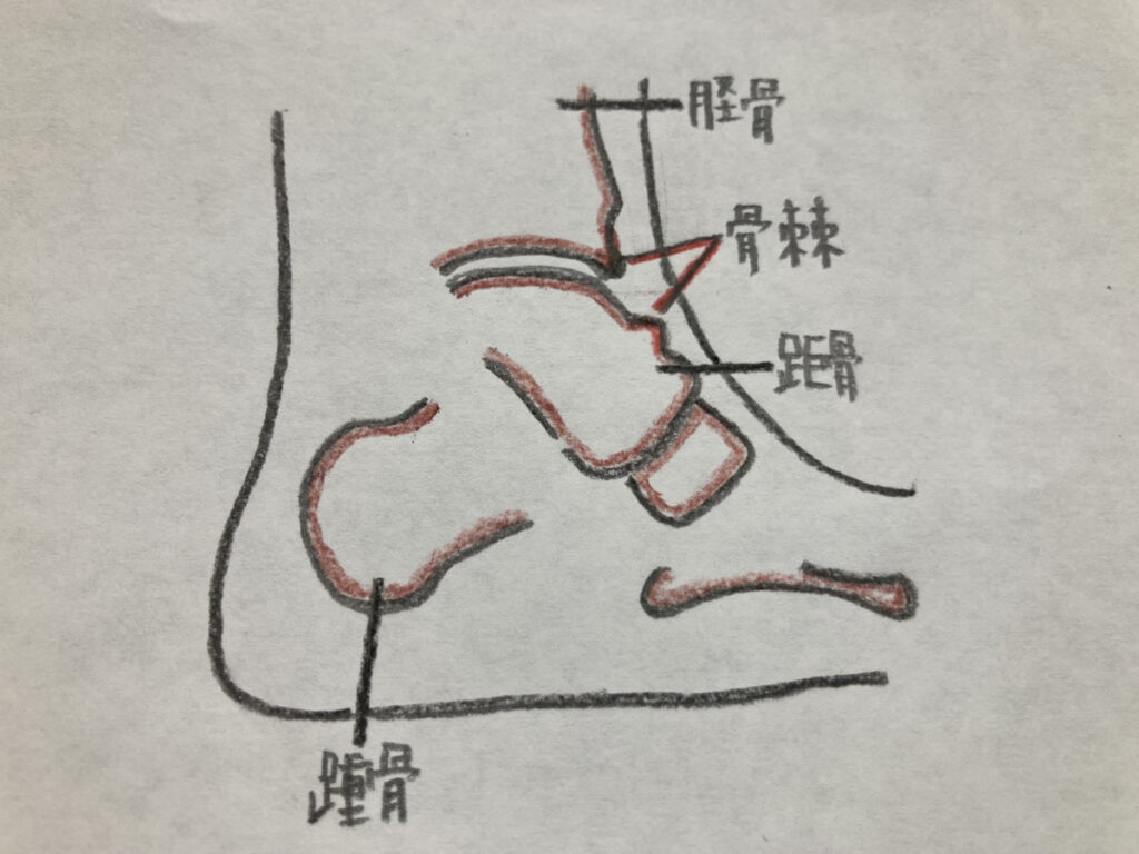 足根洞症候群