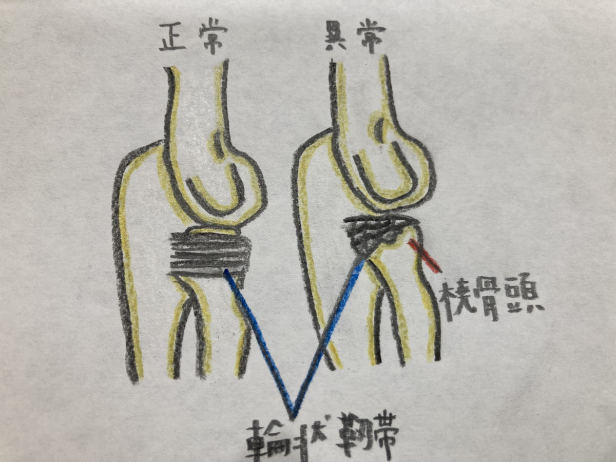 肘内障