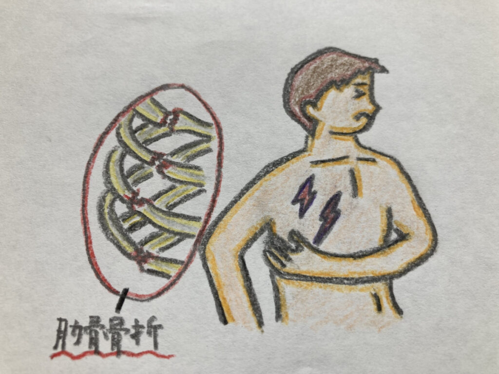 肋骨骨折