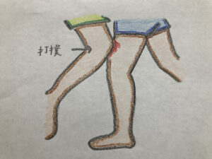 ももかん（大腿部打撲）